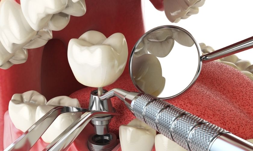 Process of a Single Tooth Implant in Chicago