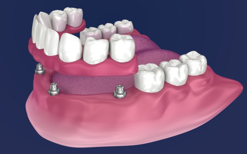 All-On-4 Implants - Lakeshore Dental Studio, IL