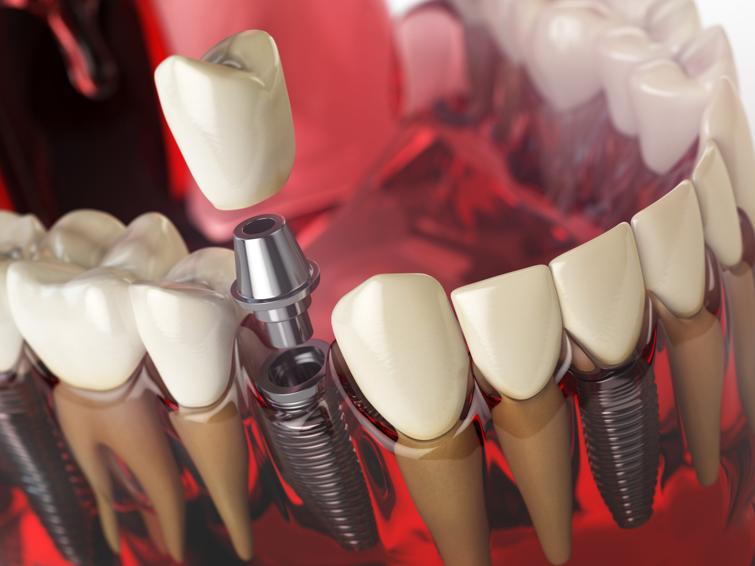 How Painful is Getting a Dental Implant Chicago Dentist's Insight - Lakeshore Dental Studio