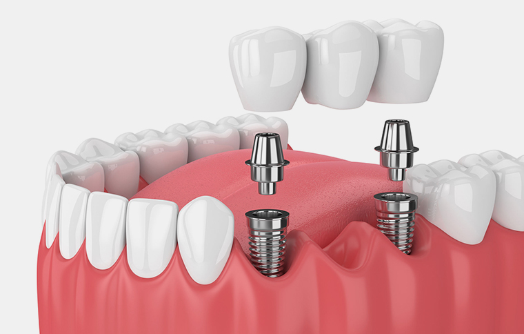 single tooth implant chicago il
