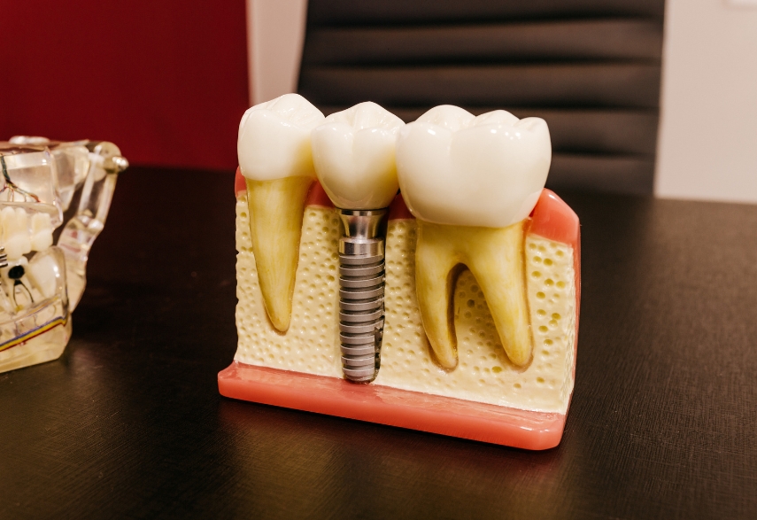 common dental implant myths debunked for chicago residents