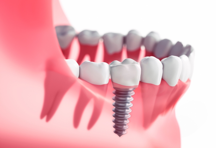 how dental implants feel like real teeth