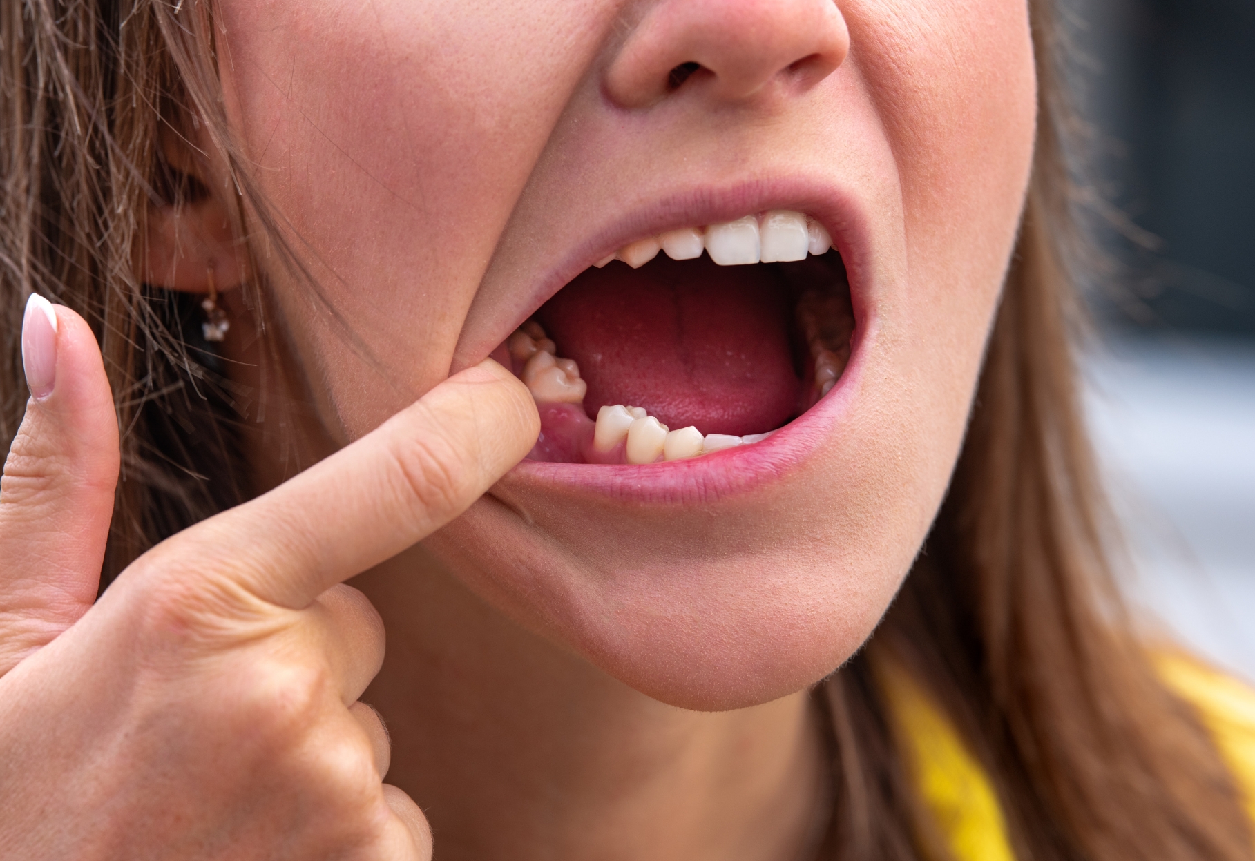 the causes symptoms and remedies of dry socket after tooth extraction