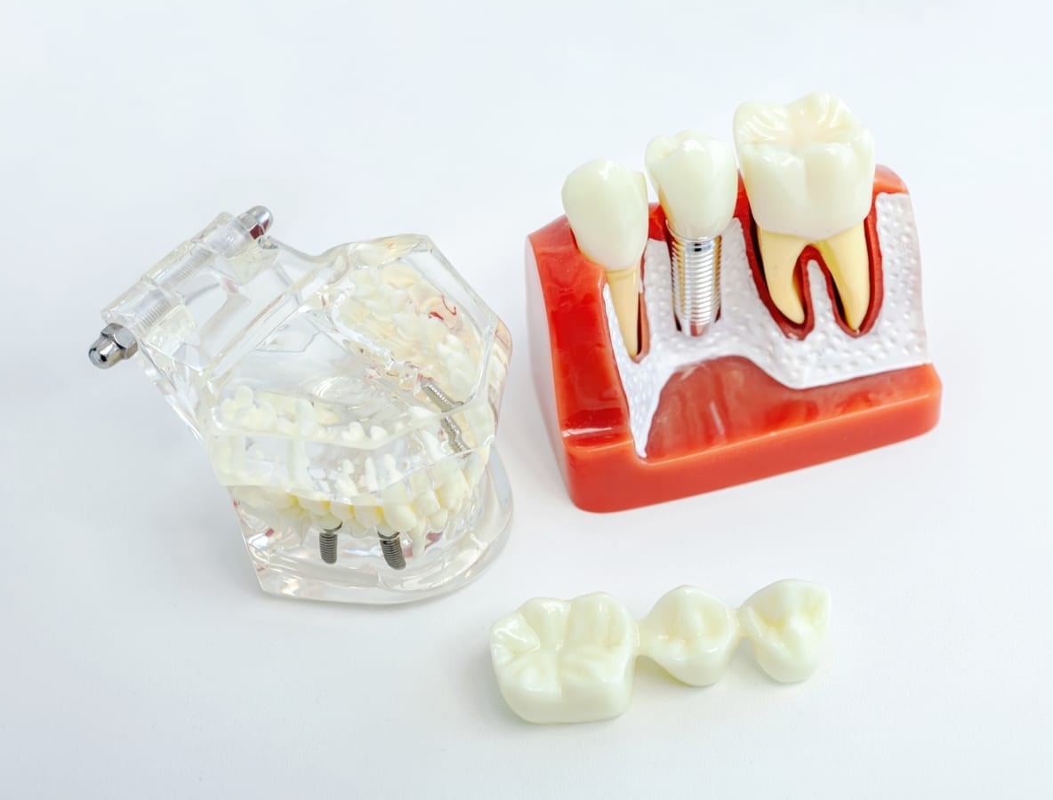 Dental Implants in Lincoln Square