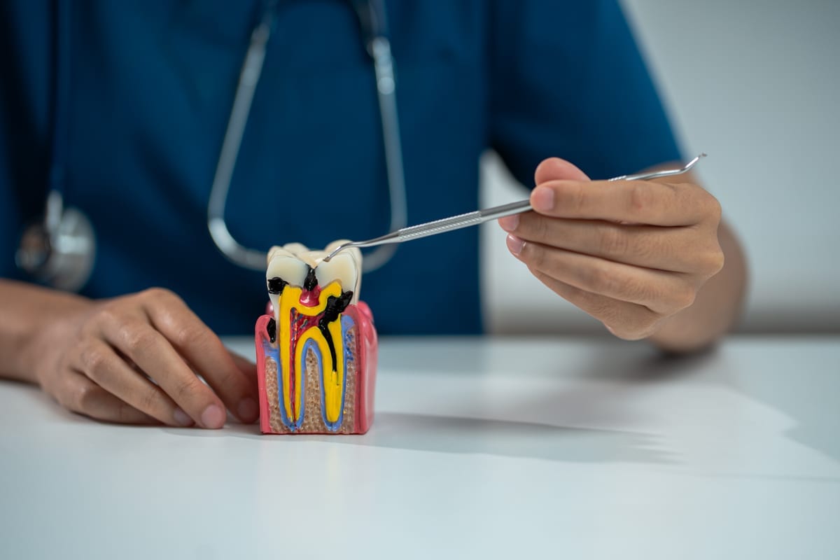 Root Canal Treatment in Chicago